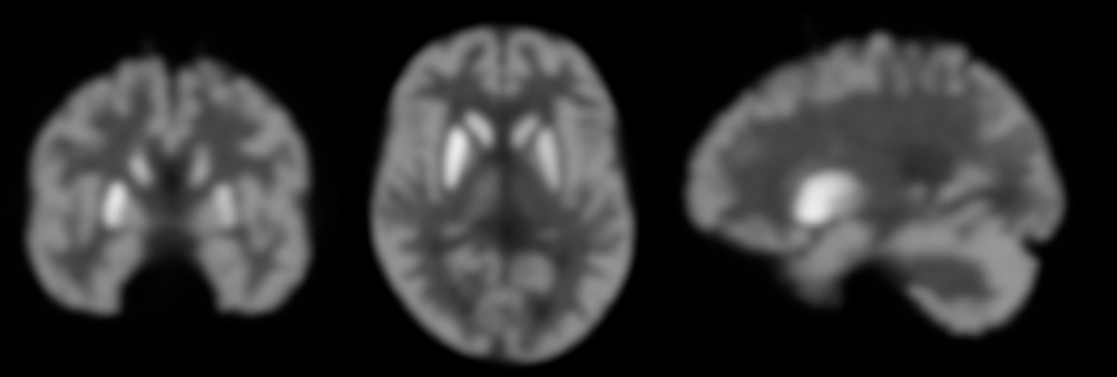 Coronal, axial, and sagittal sections of the Step-Brain prototype obtained through 18F-FDG PET/CT with contrast medium.